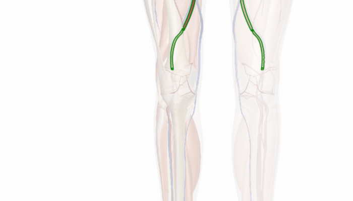 Femoral bypass artery graft illustration diagram included