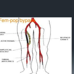 Iliac bypass fem artery stenting femoral common superficial arteries reconstruction combined occlusion end guidewire plaque