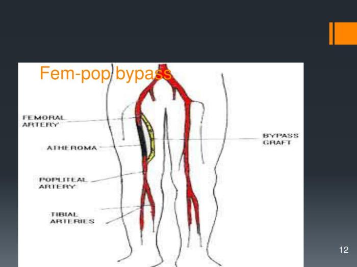 Iliac bypass fem artery stenting femoral common superficial arteries reconstruction combined occlusion end guidewire plaque