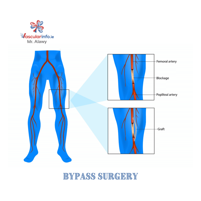 Bypass femoral tibial anterior artery graft ptfe left